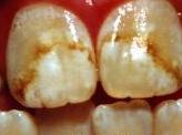 http://curezone.com/upload/_E_F_Forums/Fluoride/fluorosis.jpg