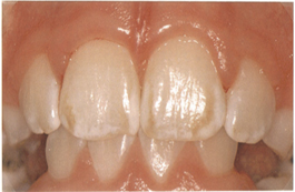 http://curezone.com/upload/_E_F_Forums/Fluoride/mildfluorosis.jpg