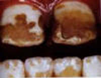 http://curezone.com/upload/_E_F_Forums/Fluoride/severefluorosis.jpg